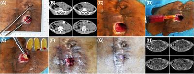 Local autologous platelet rich plasma injection combined with platelet rich fibrin filling as the main treatment for refractory wounds: A case series